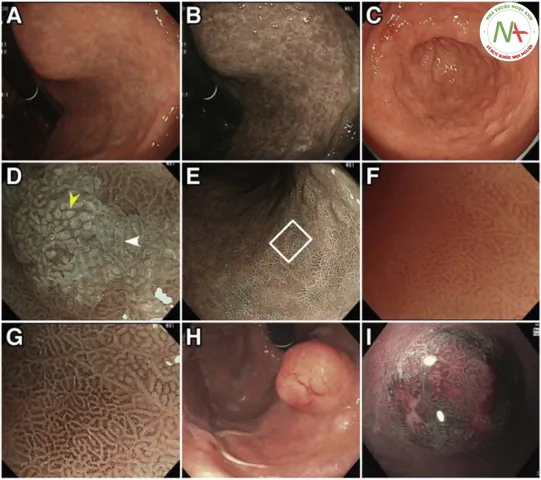 Xem Hình Ảnh Teo Da: Nguyên Nhân, Triệu Chứng Và Cách Điều Trị Cho Người Nghi Ngờ Da Mỏng Do Corticoid Xem Hình Ảnh Teo Da: Nguyên Nhân, Triệu Chứng Và Cách Điều Trị Cho Người Nghi Ngờ Da Mỏng Do Corticoid