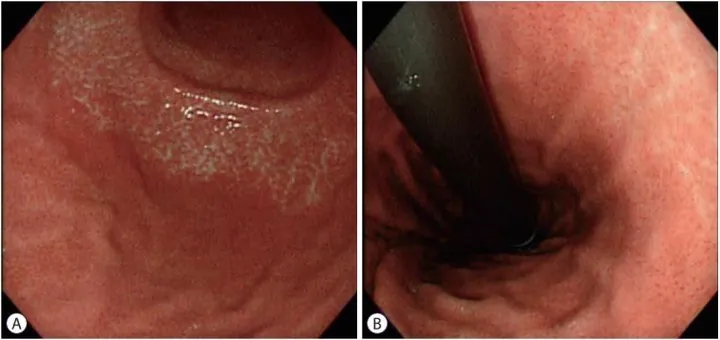 Xem Hình Ảnh Teo Da: Nguyên Nhân, Triệu Chứng Và Cách Điều Trị Cho Người Nghi Ngờ Da Mỏng Do Corticoid Xem Hình Ảnh Teo Da: Nguyên Nhân, Triệu Chứng Và Cách Điều Trị Cho Người Nghi Ngờ Da Mỏng Do Corticoid