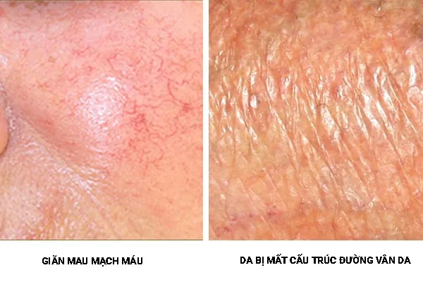 Xem Hình Ảnh Teo Da: Nguyên Nhân, Triệu Chứng Và Cách Điều Trị Cho Người Nghi Ngờ Da Mỏng Do Corticoid Xem Hình Ảnh Teo Da: Nguyên Nhân, Triệu Chứng Và Cách Điều Trị Cho Người Nghi Ngờ Da Mỏng Do Corticoid