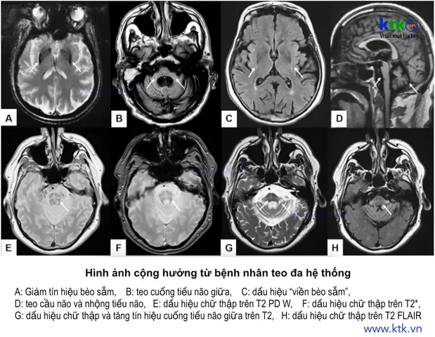Xem Hình Ảnh Teo Da: Nguyên Nhân, Triệu Chứng Và Cách Điều Trị Cho Người Nghi Ngờ Da Mỏng Do Corticoid Xem Hình Ảnh Teo Da: Nguyên Nhân, Triệu Chứng Và Cách Điều Trị Cho Người Nghi Ngờ Da Mỏng Do Corticoid