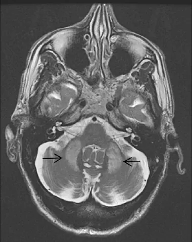 Xem Hình Ảnh Teo Da: Nguyên Nhân, Triệu Chứng Và Cách Điều Trị Cho Người Nghi Ngờ Da Mỏng Do Corticoid Xem Hình Ảnh Teo Da: Nguyên Nhân, Triệu Chứng Và Cách Điều Trị Cho Người Nghi Ngờ Da Mỏng Do Corticoid