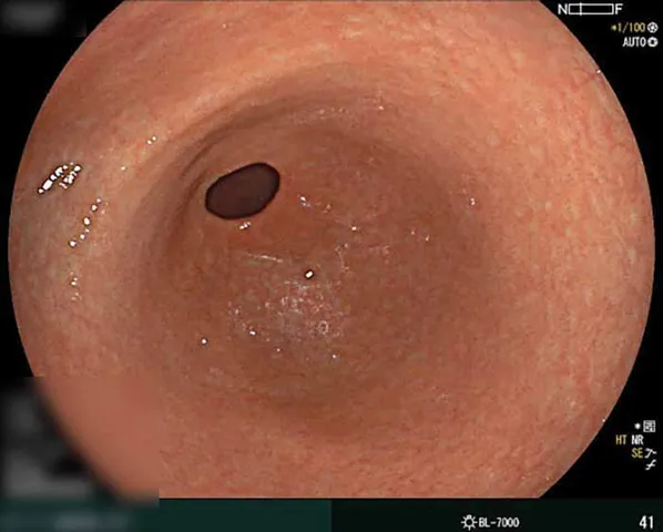 Xem Hình Ảnh Teo Da: Nguyên Nhân, Triệu Chứng Và Cách Điều Trị Cho Người Nghi Ngờ Da Mỏng Do Corticoid Xem Hình Ảnh Teo Da: Nguyên Nhân, Triệu Chứng Và Cách Điều Trị Cho Người Nghi Ngờ Da Mỏng Do Corticoid