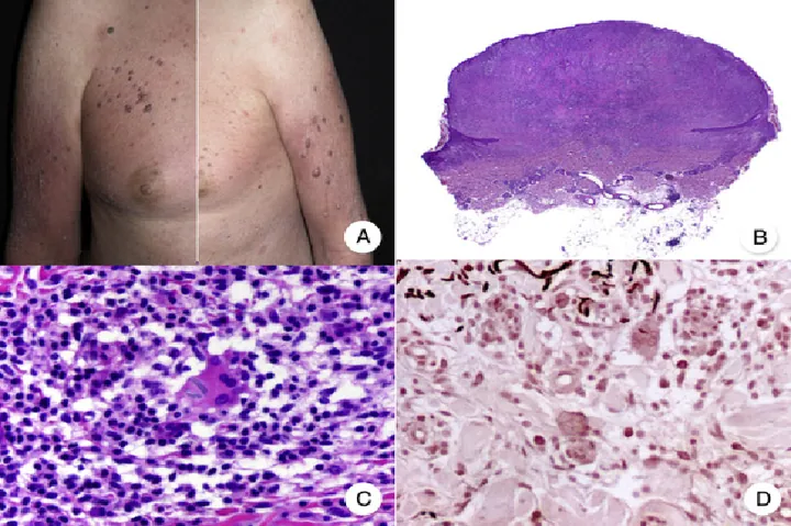 Xem Hình Ảnh Teo Da: Nguyên Nhân, Triệu Chứng Và Cách Điều Trị Cho Người Nghi Ngờ Da Mỏng Do Corticoid Xem Hình Ảnh Teo Da: Nguyên Nhân, Triệu Chứng Và Cách Điều Trị Cho Người Nghi Ngờ Da Mỏng Do Corticoid