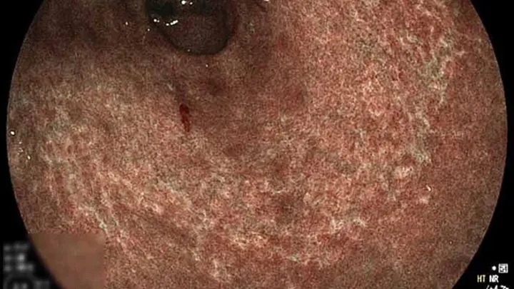Xem Hình Ảnh Teo Da: Nguyên Nhân, Triệu Chứng Và Cách Điều Trị Cho Người Nghi Ngờ Da Mỏng Do Corticoid Xem Hình Ảnh Teo Da: Nguyên Nhân, Triệu Chứng Và Cách Điều Trị Cho Người Nghi Ngờ Da Mỏng Do Corticoid