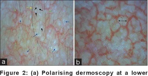 Xem Hình Ảnh Teo Da: Nguyên Nhân, Triệu Chứng Và Cách Điều Trị Cho Người Nghi Ngờ Da Mỏng Do Corticoid Xem Hình Ảnh Teo Da: Nguyên Nhân, Triệu Chứng Và Cách Điều Trị Cho Người Nghi Ngờ Da Mỏng Do Corticoid