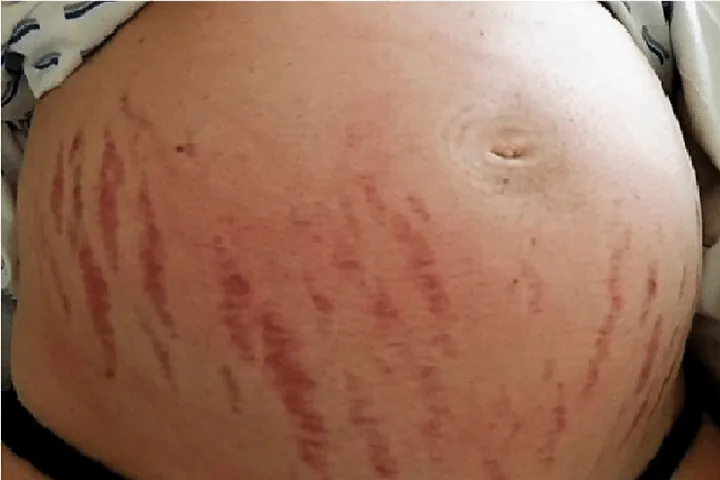 Xem Hình Ảnh Teo Da: Nguyên Nhân, Triệu Chứng Và Cách Điều Trị Cho Người Nghi Ngờ Da Mỏng Do Corticoid Xem Hình Ảnh Teo Da: Nguyên Nhân, Triệu Chứng Và Cách Điều Trị Cho Người Nghi Ngờ Da Mỏng Do Corticoid