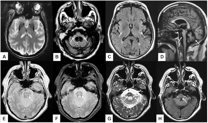 Xem Hình Ảnh Teo Da: Nguyên Nhân, Triệu Chứng Và Cách Điều Trị Cho Người Nghi Ngờ Da Mỏng Do Corticoid Xem Hình Ảnh Teo Da: Nguyên Nhân, Triệu Chứng Và Cách Điều Trị Cho Người Nghi Ngờ Da Mỏng Do Corticoid