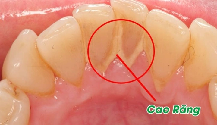 Hình Ảnh Trước & Sau Khi Lấy Cao Răng: Kết Quả Thực Tế, Quy Trình & Lưu Ý Cho Người Đọc