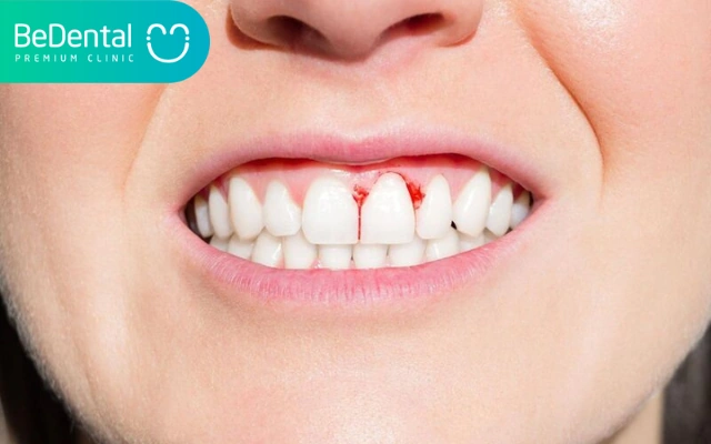 Hình Ảnh Trước & Sau Khi Lấy Cao Răng: Kết Quả Thực Tế, Quy Trình & Lưu Ý Cho Người Đọc