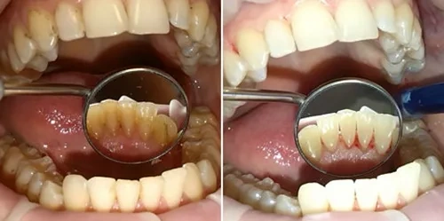Hình Ảnh Trước & Sau Khi Lấy Cao Răng: Kết Quả Thực Tế, Quy Trình & Lưu Ý Cho Người Đọc