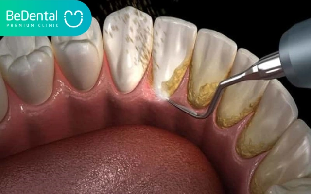 Hình Ảnh Trước & Sau Khi Lấy Cao Răng: Kết Quả Thực Tế, Quy Trình & Lưu Ý Cho Người Đọc
