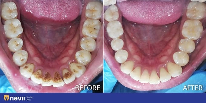 Hình Ảnh Trước & Sau Khi Lấy Cao Răng: Kết Quả Thực Tế, Quy Trình & Lưu Ý Cho Người Đọc