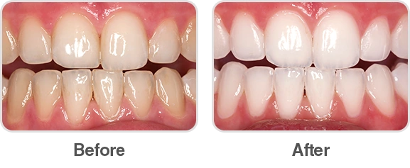 Hình Ảnh Trước & Sau Khi Lấy Cao Răng: Kết Quả Thực Tế, Quy Trình & Lưu Ý Cho Người Đọc