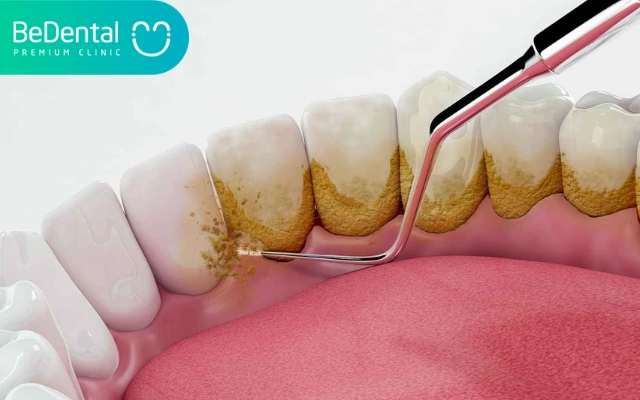 Hình Ảnh Trước & Sau Khi Lấy Cao Răng: Kết Quả Thực Tế, Quy Trình & Lưu Ý Cho Người Đọc