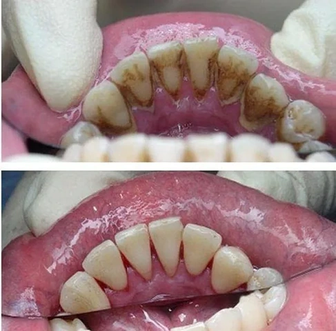 Hình Ảnh Trước & Sau Khi Lấy Cao Răng: Kết Quả Thực Tế, Quy Trình & Lưu Ý Cho Người Đọc