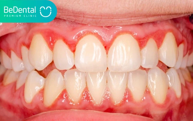Hình Ảnh Trước & Sau Khi Lấy Cao Răng: Kết Quả Thực Tế, Quy Trình & Lưu Ý Cho Người Đọc