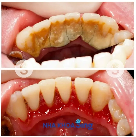Hình Ảnh Trước & Sau Khi Lấy Cao Răng: Kết Quả Thực Tế, Quy Trình & Lưu Ý Cho Người Đọc