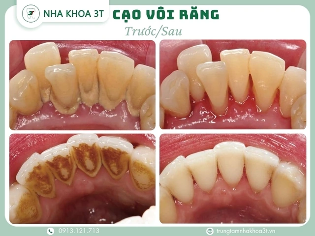 Hình Ảnh Trước & Sau Khi Lấy Cao Răng: Kết Quả Thực Tế, Quy Trình & Lưu Ý Cho Người Đọc