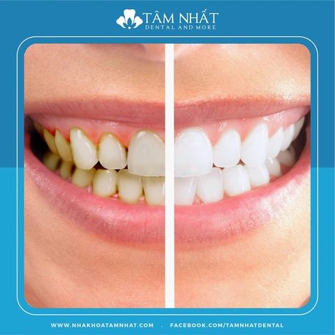 Hình Ảnh Trước & Sau Khi Lấy Cao Răng: Kết Quả Thực Tế, Quy Trình & Lưu Ý Cho Người Đọc