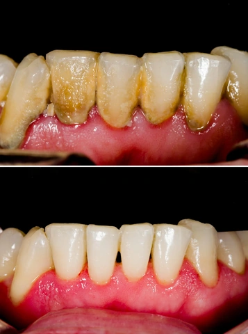 Hình Ảnh Trước & Sau Khi Lấy Cao Răng: Kết Quả Thực Tế, Quy Trình & Lưu Ý Cho Người Đọc