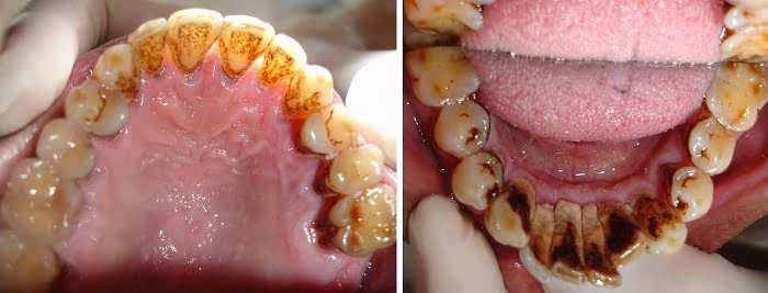 Hình Ảnh Trước & Sau Khi Lấy Cao Răng: Kết Quả Thực Tế, Quy Trình & Lưu Ý Cho Người Đọc