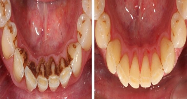 Hình Ảnh Trước & Sau Khi Lấy Cao Răng: Kết Quả Thực Tế, Quy Trình & Lưu Ý Cho Người Đọc