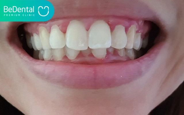 Hình Ảnh Trước & Sau Khi Lấy Cao Răng: Kết Quả Thực Tế, Quy Trình & Lưu Ý Cho Người Đọc