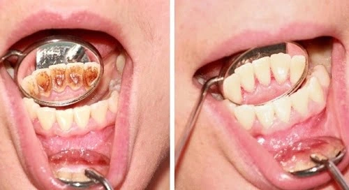 Hình Ảnh Trước & Sau Khi Lấy Cao Răng: Kết Quả Thực Tế, Quy Trình & Lưu Ý Cho Người Đọc