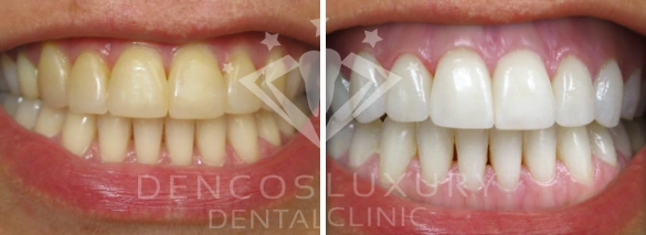 Hình Ảnh Trước & Sau Khi Lấy Cao Răng: Kết Quả Thực Tế, Quy Trình & Lưu Ý Cho Người Đọc
