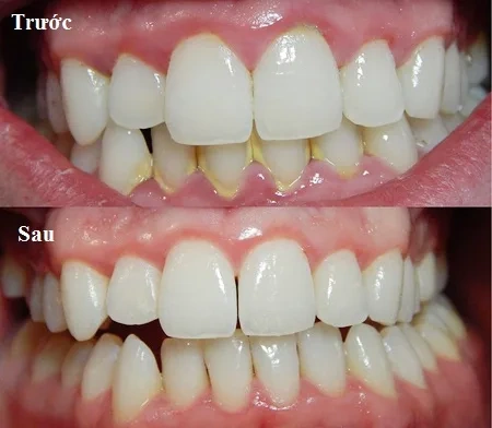 Hình Ảnh Trước & Sau Khi Lấy Cao Răng: Kết Quả Thực Tế, Quy Trình & Lưu Ý Cho Người Đọc