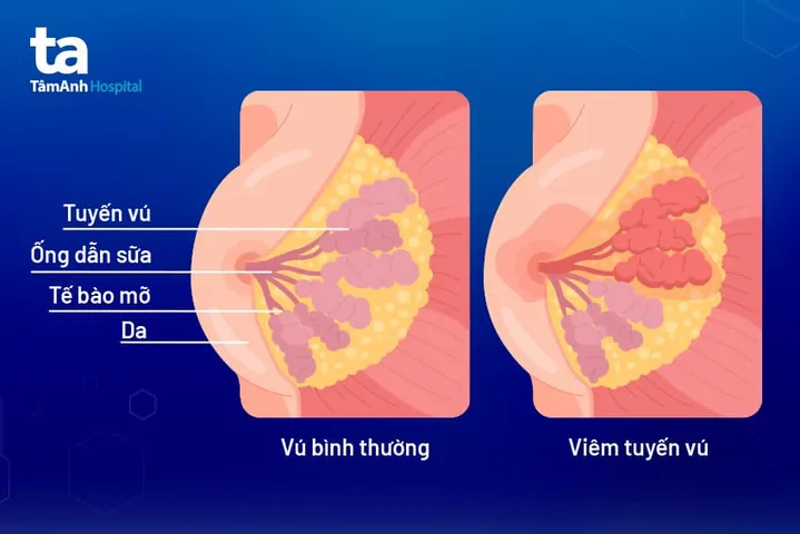 Xem Hình Ảnh Tuyến Sữa Thực Tế: Cấu Tạo, Vị Trí Và Chức Năng Ở Phụ Nữ Xem Hình Ảnh Tuyến Sữa Thực Tế: Cấu Tạo, Vị Trí Và Chức Năng Ở Phụ Nữ