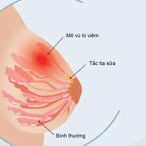 Xem Hình Ảnh Tuyến Sữa Thực Tế: Cấu Tạo, Vị Trí Và Chức Năng Ở Phụ Nữ Xem Hình Ảnh Tuyến Sữa Thực Tế: Cấu Tạo, Vị Trí Và Chức Năng Ở Phụ Nữ