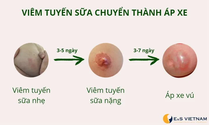 Xem Hình Ảnh Tuyến Sữa Thực Tế: Cấu Tạo, Vị Trí Và Chức Năng Ở Phụ Nữ Xem Hình Ảnh Tuyến Sữa Thực Tế: Cấu Tạo, Vị Trí Và Chức Năng Ở Phụ Nữ