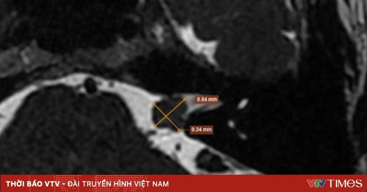 Hình Ảnh U Dây Thần Kinh Số 8: Đánh Giá Triệu Trưng, Nguyên Nhân, Chẩn Đoán & Phương Pháp Điều Trị Dành Cho Bệnh Nhân