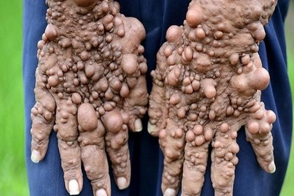 Hình Ảnh U Dây Thần Kinh Số 8: Đánh Giá Triệu Trưng, Nguyên Nhân, Chẩn Đoán & Phương Pháp Điều Trị Dành Cho Bệnh Nhân