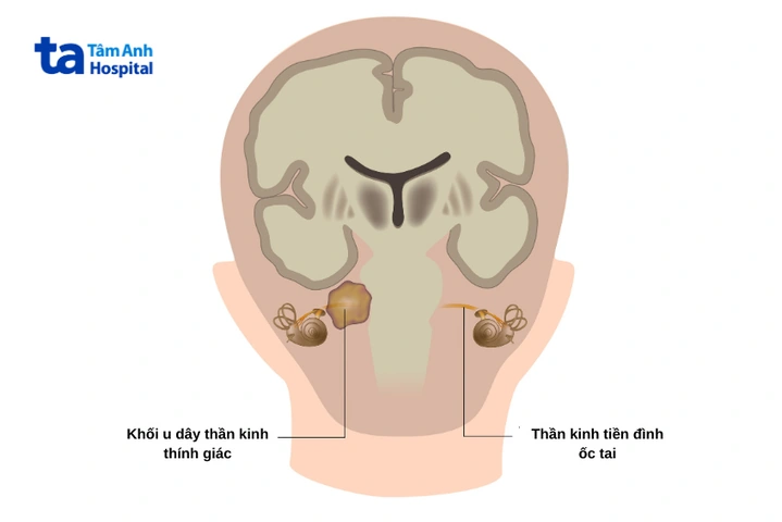 Hình Ảnh U Dây Thần Kinh Số 8: Đánh Giá Triệu Trưng, Nguyên Nhân, Chẩn Đoán & Phương Pháp Điều Trị Dành Cho Bệnh Nhân