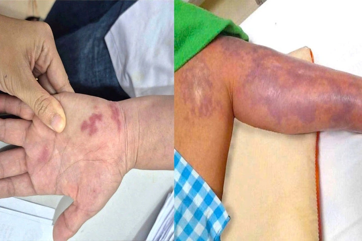 Hình Ảnh Vi Khuẩn “ăn Thịt Người”: Định Nghĩa, Nguyên Nhân, Triệu Chứng & Cách Phòng Ngừa Cho Người Đọc Việt Nam Hình Ảnh Vi Khuẩn “ăn Thịt Người”: Định Nghĩa, Nguyên Nhân, Triệu Chứng & Cách Phòng Ngừa Cho Người Đọc Việt Nam