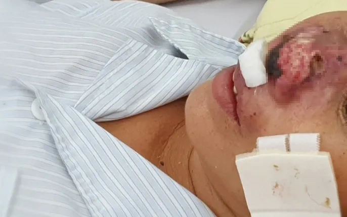 Hình Ảnh Vi Khuẩn “ăn Thịt Người”: Định Nghĩa, Nguyên Nhân, Triệu Chứng & Cách Phòng Ngừa Cho Người Đọc Việt Nam Hình Ảnh Vi Khuẩn “ăn Thịt Người”: Định Nghĩa, Nguyên Nhân, Triệu Chứng & Cách Phòng Ngừa Cho Người Đọc Việt Nam
