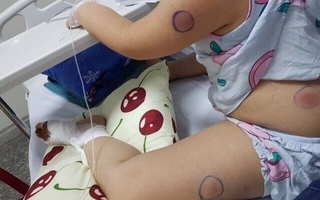 Hình Ảnh Vi Khuẩn “ăn Thịt Người”: Định Nghĩa, Nguyên Nhân, Triệu Chứng & Cách Phòng Ngừa Cho Người Đọc Việt Nam Hình Ảnh Vi Khuẩn “ăn Thịt Người”: Định Nghĩa, Nguyên Nhân, Triệu Chứng & Cách Phòng Ngừa Cho Người Đọc Việt Nam