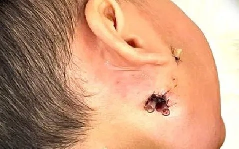 Hình Ảnh Vi Khuẩn “ăn Thịt Người”: Định Nghĩa, Nguyên Nhân, Triệu Chứng & Cách Phòng Ngừa Cho Người Đọc Việt Nam Hình Ảnh Vi Khuẩn “ăn Thịt Người”: Định Nghĩa, Nguyên Nhân, Triệu Chứng & Cách Phòng Ngừa Cho Người Đọc Việt Nam