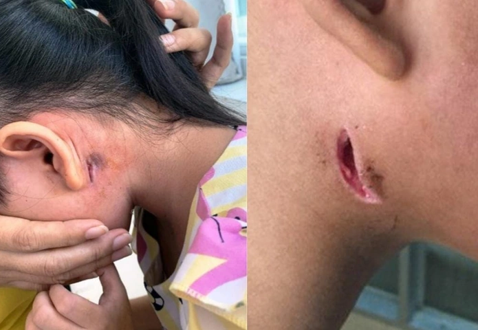 Hình Ảnh Vi Khuẩn “ăn Thịt Người”: Định Nghĩa, Nguyên Nhân, Triệu Chứng & Cách Phòng Ngừa Cho Người Đọc Việt Nam Hình Ảnh Vi Khuẩn “ăn Thịt Người”: Định Nghĩa, Nguyên Nhân, Triệu Chứng & Cách Phòng Ngừa Cho Người Đọc Việt Nam