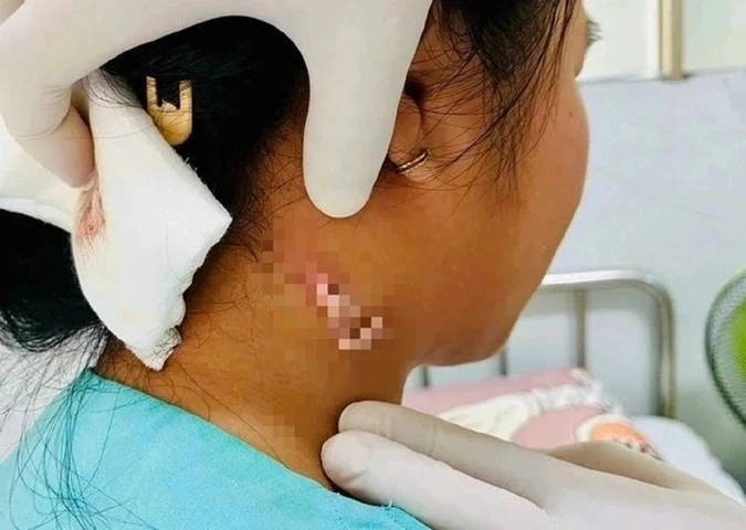 Hình Ảnh Vi Khuẩn “ăn Thịt Người”: Định Nghĩa, Nguyên Nhân, Triệu Chứng & Cách Phòng Ngừa Cho Người Đọc Việt Nam Hình Ảnh Vi Khuẩn “ăn Thịt Người”: Định Nghĩa, Nguyên Nhân, Triệu Chứng & Cách Phòng Ngừa Cho Người Đọc Việt Nam