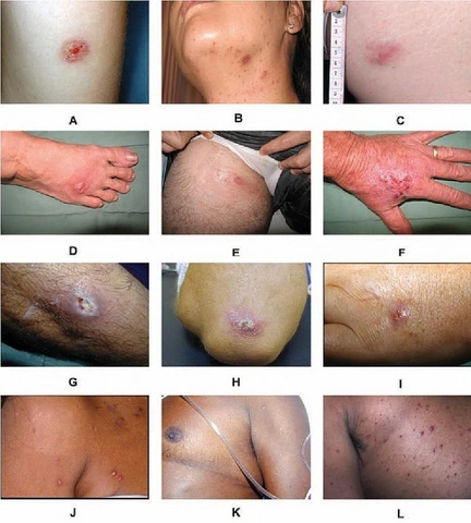 Hình Ảnh Vi Khuẩn “ăn Thịt Người”: Định Nghĩa, Nguyên Nhân, Triệu Chứng & Cách Phòng Ngừa Cho Người Đọc Việt Nam Hình Ảnh Vi Khuẩn “ăn Thịt Người”: Định Nghĩa, Nguyên Nhân, Triệu Chứng & Cách Phòng Ngừa Cho Người Đọc Việt Nam