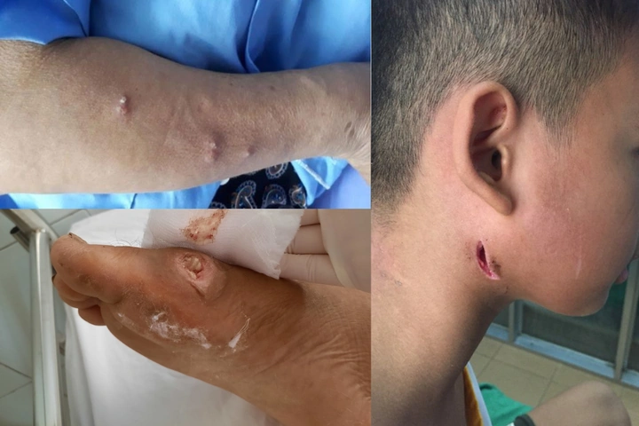 Hình Ảnh Vi Khuẩn “ăn Thịt Người”: Định Nghĩa, Nguyên Nhân, Triệu Chứng & Cách Phòng Ngừa Cho Người Đọc Việt Nam Hình Ảnh Vi Khuẩn “ăn Thịt Người”: Định Nghĩa, Nguyên Nhân, Triệu Chứng & Cách Phòng Ngừa Cho Người Đọc Việt Nam