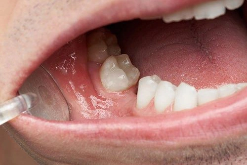 Hình Ảnh Vi Khuẩn Trong Khoang Miệng: Đánh Giá Chi Tiết, Loại Vi Khuẩn Và Ảnh Hưởng Tới Sức Khỏe (dành Cho Người Tìm Hiểu Y Khoa & Bệnh Nhân) Hình Ảnh Vi Khuẩn Trong Khoang Miệng: Đánh Giá Chi Tiết, Loại Vi Khuẩn Và Ảnh Hưởng Tới Sức Khỏe (dành Cho Người Tìm Hiểu Y Khoa & Bệnh Nhân)