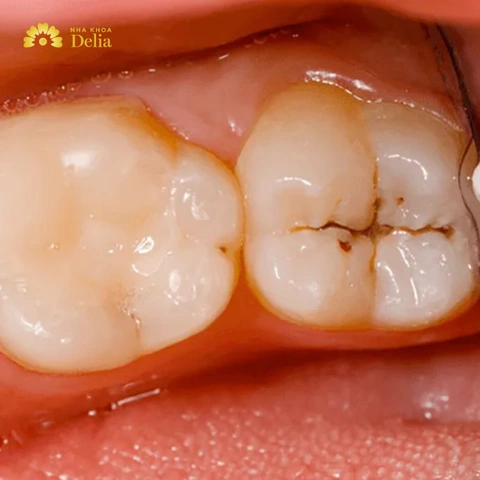 Hình Ảnh Vi Khuẩn Trong Khoang Miệng: Đánh Giá Chi Tiết, Loại Vi Khuẩn Và Ảnh Hưởng Tới Sức Khỏe (dành Cho Người Tìm Hiểu Y Khoa & Bệnh Nhân) Hình Ảnh Vi Khuẩn Trong Khoang Miệng: Đánh Giá Chi Tiết, Loại Vi Khuẩn Và Ảnh Hưởng Tới Sức Khỏe (dành Cho Người Tìm Hiểu Y Khoa & Bệnh Nhân)