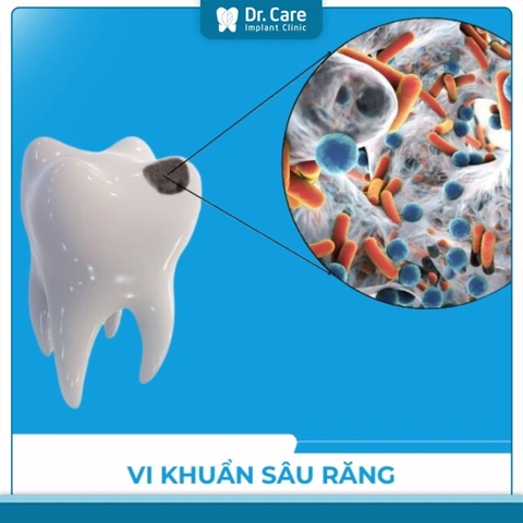 Hình Ảnh Vi Khuẩn Trong Khoang Miệng: Đánh Giá Chi Tiết, Loại Vi Khuẩn Và Ảnh Hưởng Tới Sức Khỏe (dành Cho Người Tìm Hiểu Y Khoa & Bệnh Nhân) Hình Ảnh Vi Khuẩn Trong Khoang Miệng: Đánh Giá Chi Tiết, Loại Vi Khuẩn Và Ảnh Hưởng Tới Sức Khỏe (dành Cho Người Tìm Hiểu Y Khoa & Bệnh Nhân)