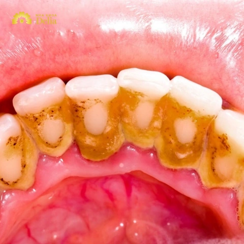 Hình Ảnh Vi Khuẩn Trong Khoang Miệng: Đánh Giá Chi Tiết, Loại Vi Khuẩn Và Ảnh Hưởng Tới Sức Khỏe (dành Cho Người Tìm Hiểu Y Khoa & Bệnh Nhân) Hình Ảnh Vi Khuẩn Trong Khoang Miệng: Đánh Giá Chi Tiết, Loại Vi Khuẩn Và Ảnh Hưởng Tới Sức Khỏe (dành Cho Người Tìm Hiểu Y Khoa & Bệnh Nhân)