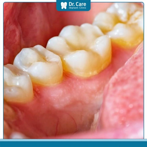 Hình Ảnh Vi Khuẩn Trong Khoang Miệng: Đánh Giá Chi Tiết, Loại Vi Khuẩn Và Ảnh Hưởng Tới Sức Khỏe (dành Cho Người Tìm Hiểu Y Khoa & Bệnh Nhân) Hình Ảnh Vi Khuẩn Trong Khoang Miệng: Đánh Giá Chi Tiết, Loại Vi Khuẩn Và Ảnh Hưởng Tới Sức Khỏe (dành Cho Người Tìm Hiểu Y Khoa & Bệnh Nhân)