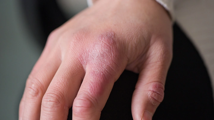 Hình Ảnh Viêm Da Cơ Địa Ở Người Lớn: Đánh Giá Trực Quan, Nguyên Nhân, Và Phương Pháp Điều Trị Hiệu Quả Cho Người Trưởng Thành